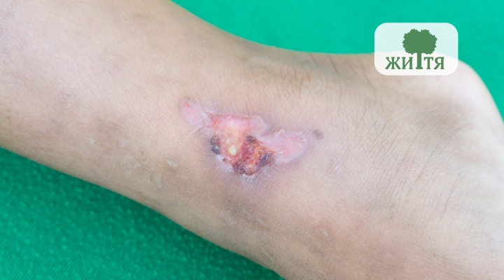 Open skin wound on the top of a foot with pink tissue and a dark crust, surrounded by slight reddening.